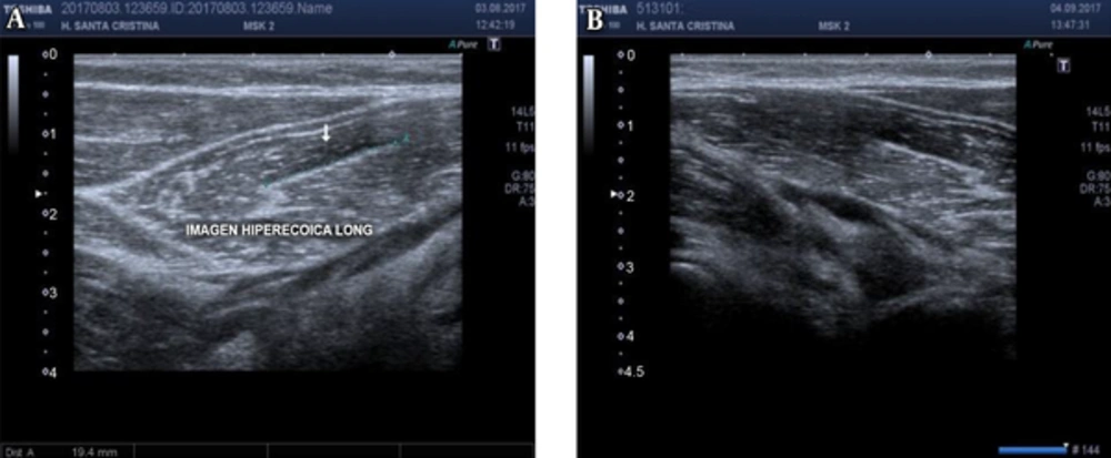 Evolution of Fibrilar Rupture Of Biceps Brachi (A) After 1 Month Follow-Up (B) is Observed. Evolution of Fibrilar Rupture Of Biceps Brachi (A) After 1 Month Follow-Up (B) is Observed.