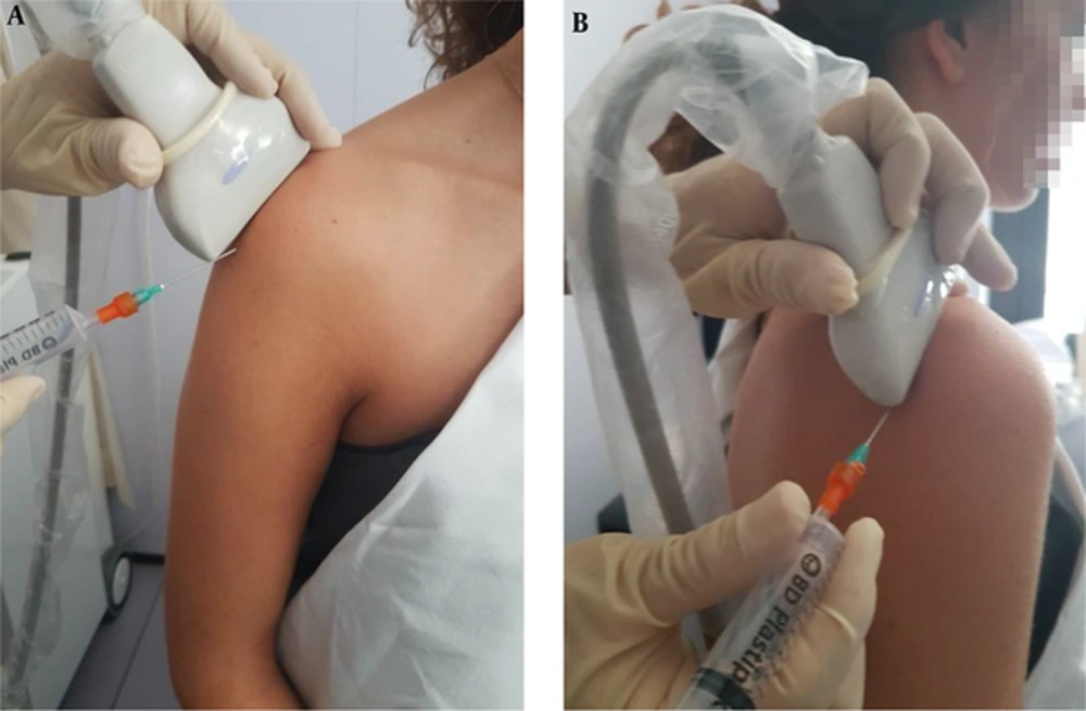 US Can Guide Interventional Procedures, Like Infiltration of Subacromial Bursa (A) or Intra Articular Infiltration (B). US Can Guide Interventional Procedures, Like Infiltration of Subacromial Bursa (A) or Intra Articular Infiltration (B).