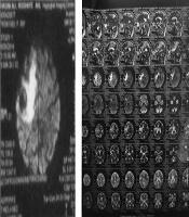 Cover image of the article: Investigation of Speech and Language in a Persian Patient with Crossed Aphasia in Dextrals: A Case Report