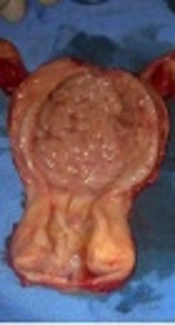 Endometrial adenofibroma; A Case Report