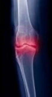 Ozone (O2 - O3) Has SYSADOA (Symptomatic Slow Acting Drug for Osteoarthritis) and DMDOA (Disease Modifying Drug for Osteoarthritis) Effect in Knee Osteoarthritis Patients