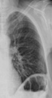 Hydrothorax After Cytoreductive Laparotomy of an Ovarian Tumor is a Feature of Pseudo-Meigs Syndrome: Case Report