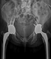 Cover image of the article: Femoral Nerve Injury: Complication After Hip Arthroplasty and Secondary Acetabular Fracture: A Case Report and Review of Literature