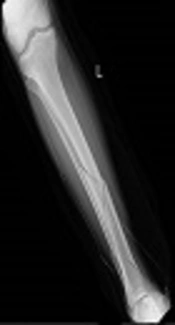 The Effect of Isometric Exercise on Pain Severity and Muscle Strength of Patients with Lower Limb Fractures: A Randomized Clinical Trial Study