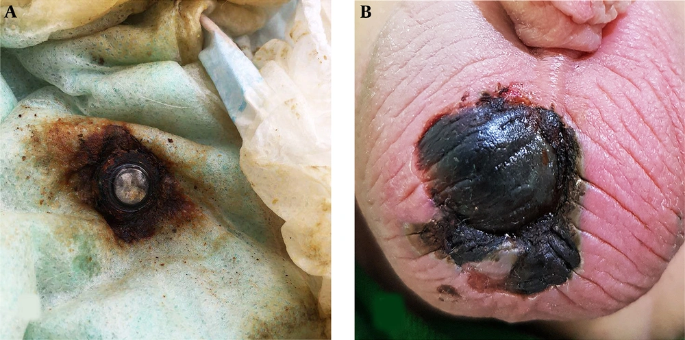 Pictures provided by the parents. A, Battery and its leakage in baby diaper; B, the rounded wound at the center of the scrotum Pictures provided by the parents. A, Battery and its leakage in baby diaper; B, the rounded wound at the center of the scrotum