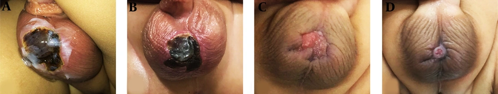 Images of the site of the lesion after A, two days; B, one week; C, two weeks; and D, one month after the start of treatment. As the pictures clearly show, the patient has passed a recovery process and no wound symptoms are observed in the site after one month of treatment initiation. Images of the site of the lesion after A, two days; B, one week; C, two weeks; and D, one month after the start of treatment. As the pictures clearly show, the patient has passed a recovery process and no wound symptoms are observed in the site after one month of treatment initiation.