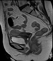 Cover image of the article: A Rare Case of Vasculitis ANCA of Bladder and Urethra Providing to Vesicovaginal Fistula and Early Recurrence of Illness