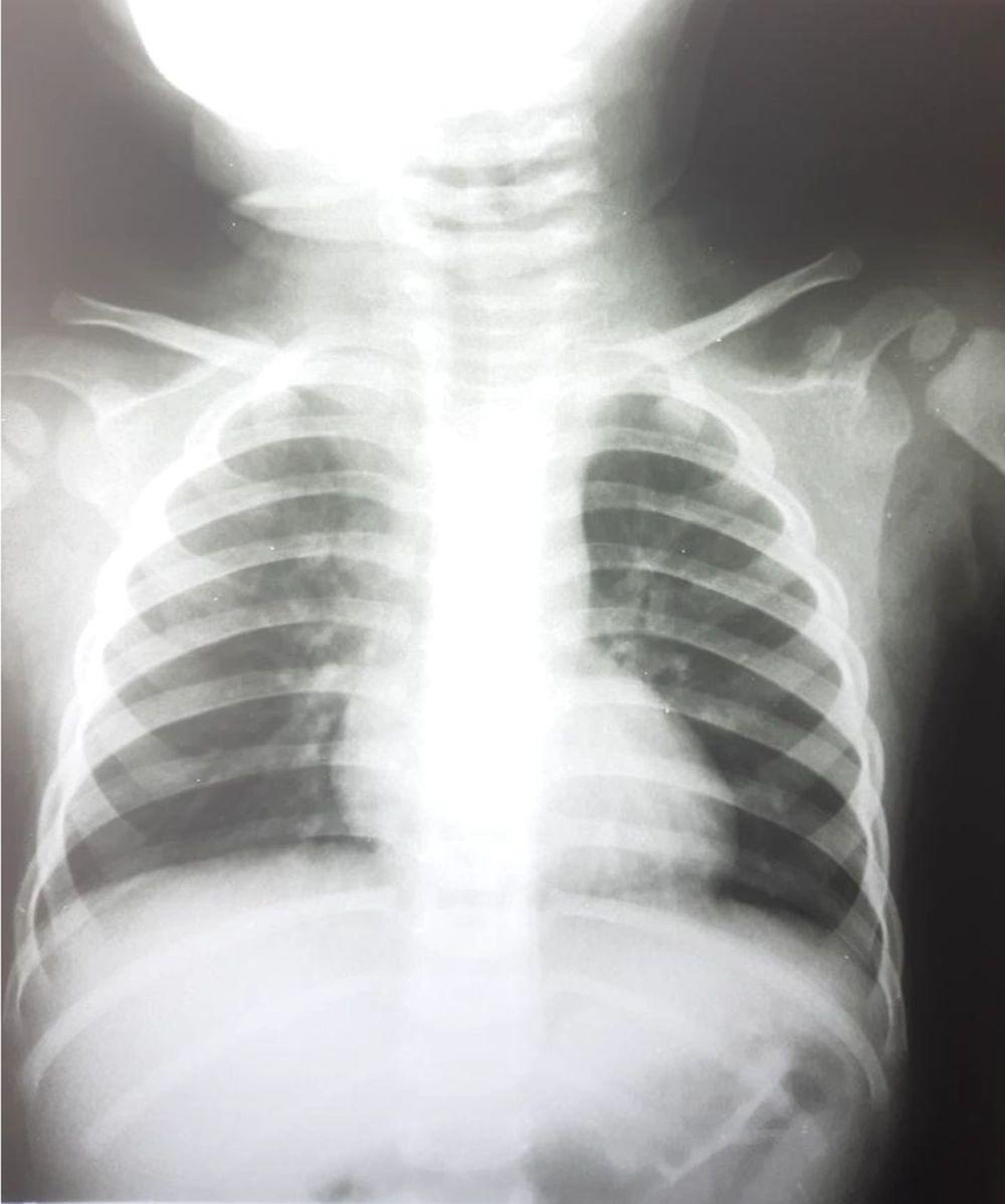 Chest X-ray of the patient affected by SARS-CoV-2 Chest X-ray of the patient affected by SARS-CoV-2