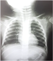 Case Report: A Pediatric COVID-19 Patient with Pyelonephritis and Febrile Seizure as a Rare Clinical Manifestations