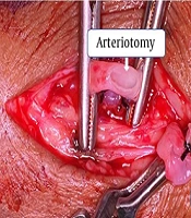 Evaluation of Factors Affecting Wrist Radio-Cephalic Arteriovenous Fistula Maturation: A Single Institutional Observational Study