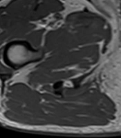 Cancer of Male Urethra: Case Series and Review of Literature