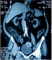 A Comparison Between the Effects of Calcium Acetate and Sevelamer Carbonate on Progression of Aortic Vascular Calcification in Patients with Chronic Kidney Disease Stages 4 and 5
