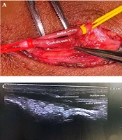 Vascular Factors Affecting Outcomes of Snuffbox AV Fistula with Side-to-Side Anastomosis: A Single Institutional Observational Study
