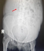 Renal Papillary Necrosis Associated with Multiple Risk Factors: A Case Report