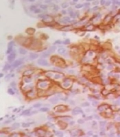 Expression of Programmed Death-1 Ligand in Renal Cell Carcinoma and Its Relationship with Pathologic Findings and Disease-Free Survival