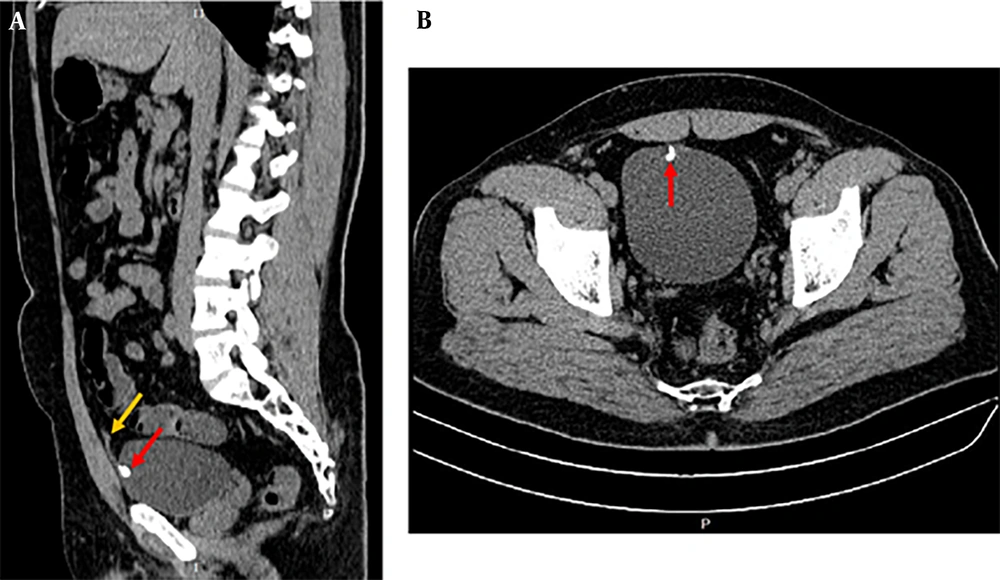The images of the computerized tomography (CT) scan in both sagittal (A); and axial (B); axes show a calculus (red arrow) with the size of 10 mm attached to the anterior and inner wall of the bladder, which was exactly located in the insertion of the bladder to the urachus. The yellow arrow shows the portion of the urachus. The images of the computerized tomography (CT) scan in both sagittal (A); and axial (B); axes show a calculus (red arrow) with the size of 10 mm attached to the anterior and inner wall of the bladder, which was exactly located in the insertion of the bladder to the urachus. The yellow arrow shows the portion of the urachus.