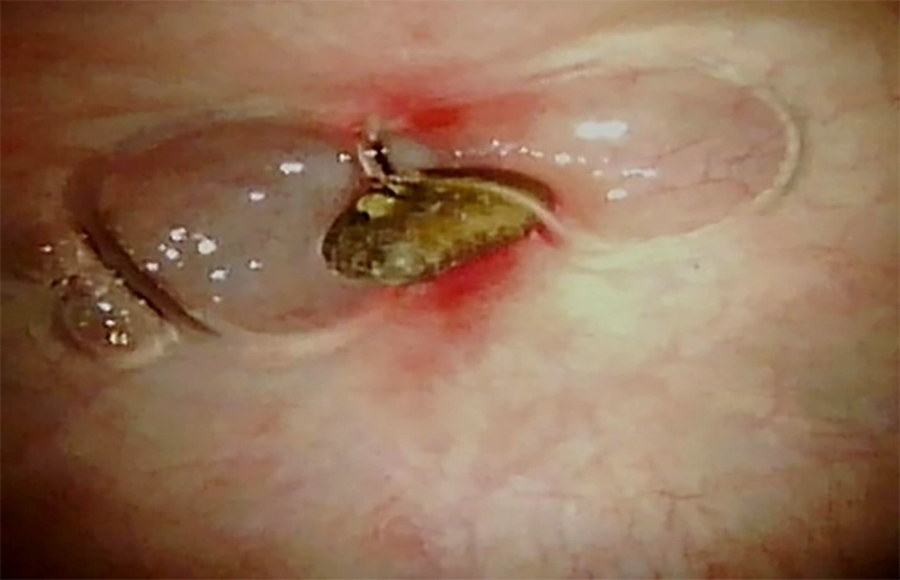 Cystoscopy image shows a calculus connected to the urachus duct without any tumor or mass. Cystoscopy image shows a calculus connected to the urachus duct without any tumor or mass.