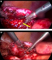 Low Intraoperative Bleeding During Laparoscopic Nephrolithotomy: A Case Report