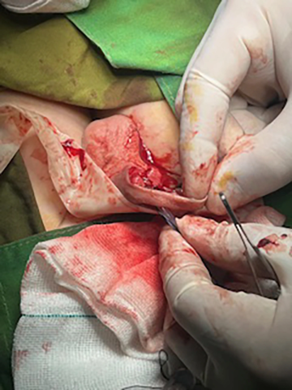 Prepuce transferring to ventral through button- hole Prepuce transferring to ventral through button- hole