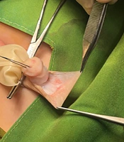 Comparative Outcomes of Preputial Buttonhole Flap and Byars Flap Techniques in Hypospadias Repair: A Cohort Study