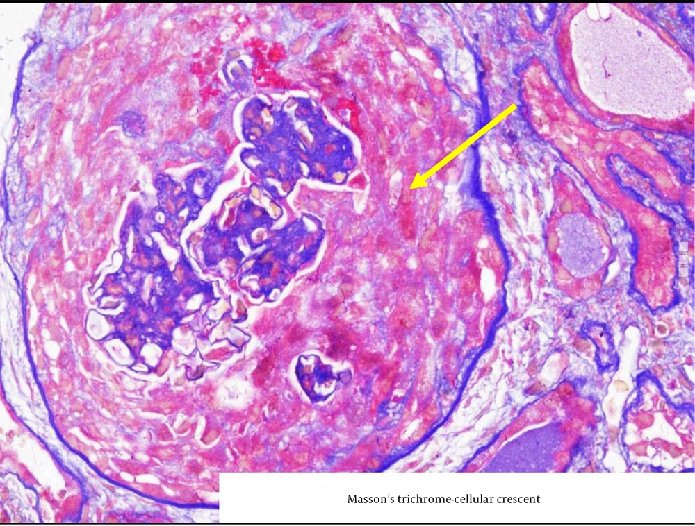 Masson-trichrome stain showing a circumferential cellular crescent (the yellow arrow shows a circumferential crescent). Masson-trichrome stain showing a circumferential cellular crescent (the yellow arrow shows a circumferential crescent).