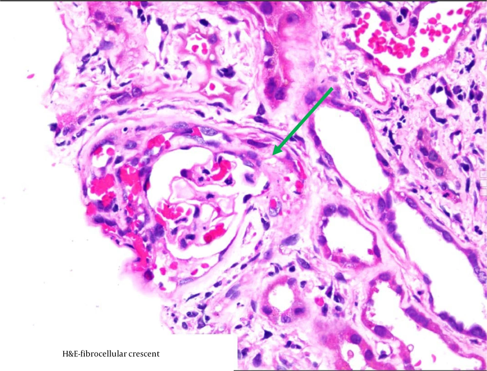 The green arrow pointing at a fibro-cellular crescent in a patient (the stain is haematoxylin-eosin). The green arrow pointing at a fibro-cellular crescent in a patient (the stain is haematoxylin-eosin).