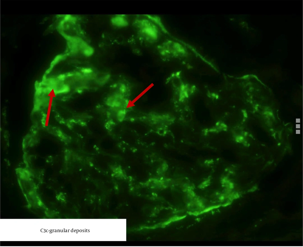 Immunofluorescence showing C3 deposition (marked in red arrows). Immunofluorescence showing C3 deposition (marked in red arrows).