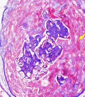 Clinical Profile, Treatment Outcomes, and Complement Pathway Involvement in Idiopathic ANCA-negative Renal-Limited Pauci-immune Crescentic Glomerulonephritis: A Single-Centre Prospective Study