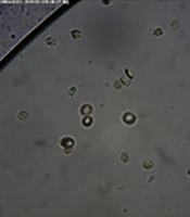 Testicular Mapping Biopsy in Non-obstructive Azoospermia (NOA) Patients: A Case Series from Indonesia