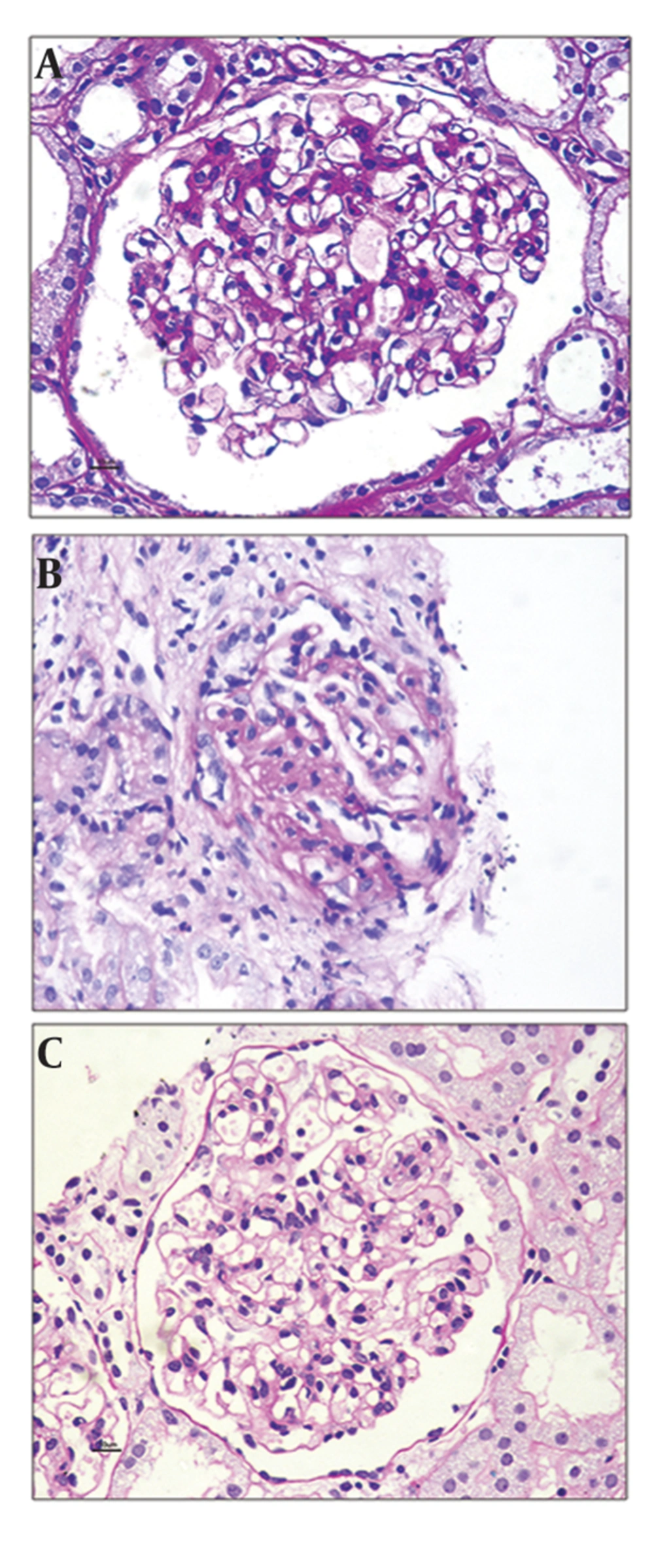 A) Minimal change disease - like morphology in C1q nephropathy. B) Focal and segmental glomerulosclerosis in C1q nephropathy. C) Mild degree of mesangial cell proliferation affecting globally in C1q nephropathy. A) Minimal change disease - like morphology in C1q nephropathy. B) Focal and segmental glomerulosclerosis in C1q nephropathy. C) Mild degree of mesangial cell proliferation affecting globally in C1q nephropathy.