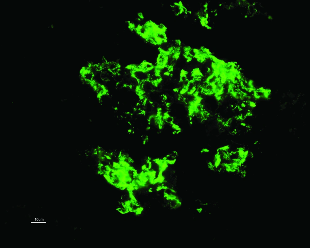 Intense Mesangial Deposition of C1q (3+) Intense Mesangial Deposition of C1q (3+)