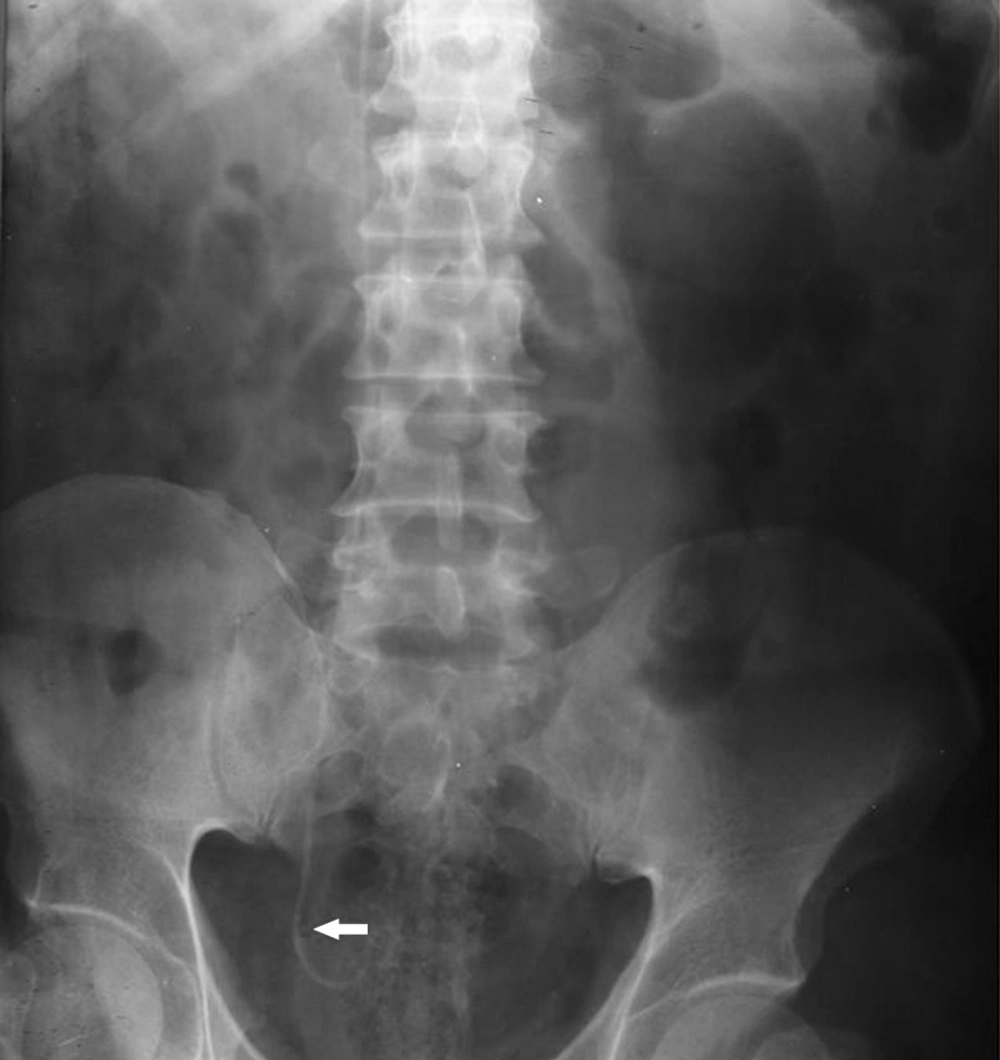 KUB After Placement of DJ Stent in Right Ureter The X-ray revealed an abnormal pathway of the double-J stent that probably entered into the inferior vena cava. The arrow shows the position of the ureteral stone, 8 × 6 mm in size, at the ureterovesical junction.