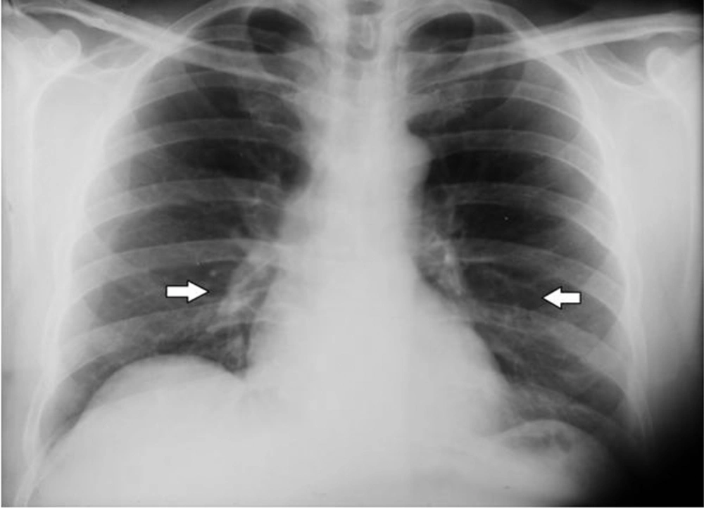 CXR After the DJ Stent was not Detected in the KUB The arrows show the abnormal density, which was the shadow of the stent.