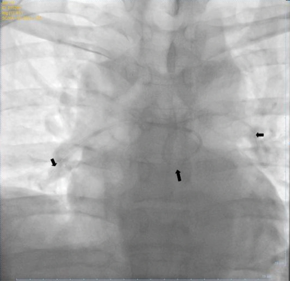 Fluoroscopic View of Pulmonary Angiography Showed that the DJ Stent was Completely in the Pulmonary Artery Fluoroscopic View of Pulmonary Angiography Showed that the DJ Stent was Completely in the Pulmonary Artery