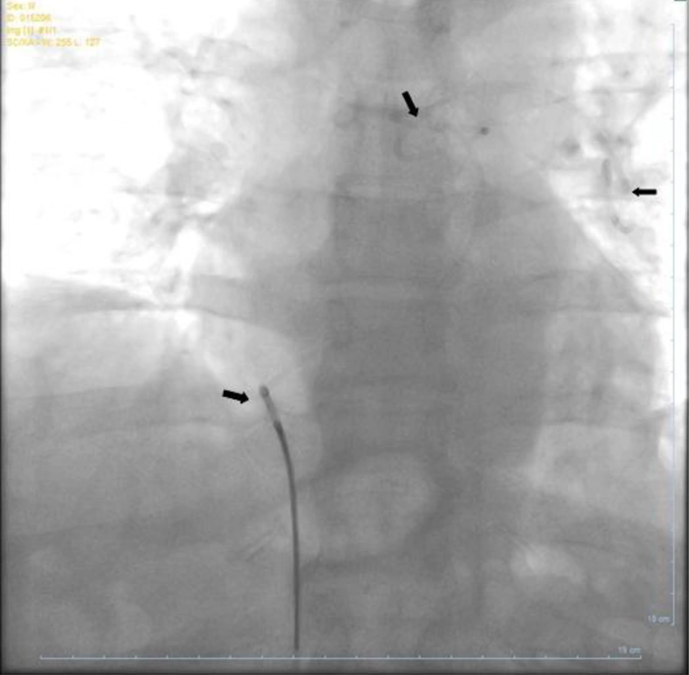 Fluoroscopic View of Chest When the peripheral snare was introduced percutaneously from the femoral sheath, and the tip of the stent was captured by it.