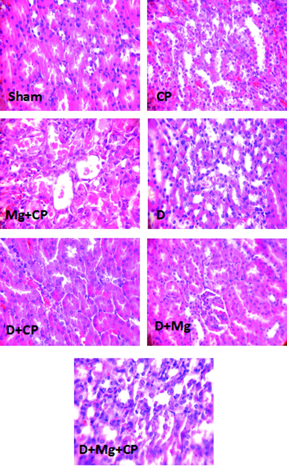 The Images of Kidney Tissues (Magnification x 100) in Sham, Cisplatin (CP) Alone Treated, Magnesium Plus CP (Mg + CP) Treated, Diabetic rats (D), Diabetic rats Treated With CP (D + CP), Diabetic Rats Treated With Mg (D + Mg), and Diabetic Rats Treated With the Combination of Mg and CP (D + Mg + CP). More Kidney Tissue Damage Was Observed in Mg + CP and D + Mg + CP Groups, While no Damage Was Detected in the Sham and D Groups. The Images of Kidney Tissues (Magnification x 100) in Sham, Cisplatin (CP) Alone Treated, Magnesium Plus CP (Mg + CP) Treated, Diabetic rats (D), Diabetic rats Treated With CP (D + CP), Diabetic Rats Treated With Mg (D + Mg), and Diabetic Rats Treated With the Combination of Mg and CP (D + Mg + CP). More Kidney Tissue Damage Was Observed in Mg + CP and D + Mg + CP Groups, While no Damage Was Detected in the Sham and D Groups.