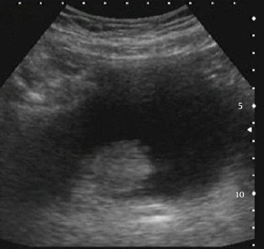 Transabdominal Ultrasound: Abnormal Thickening of Luminal Bladder, With Presence of Nodules. Transabdominal Ultrasound: Abnormal Thickening of Luminal Bladder, With Presence of Nodules.