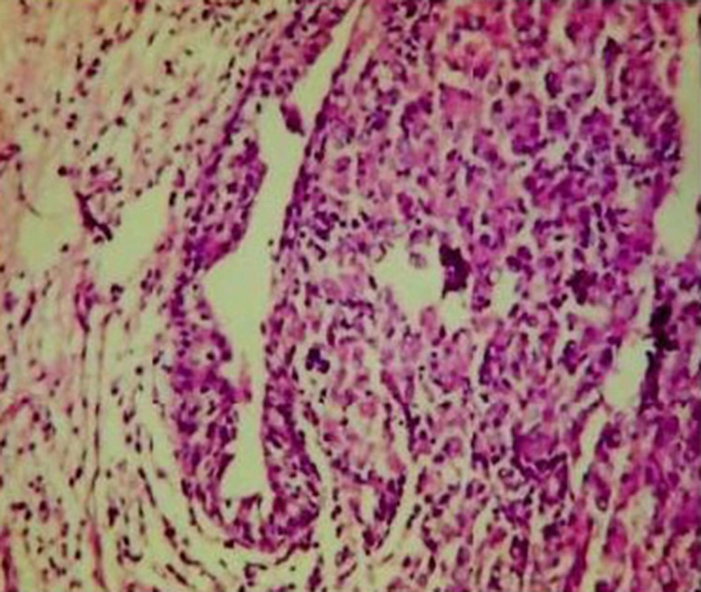 Pathognomonic Histological Inflammatory Infiltrates (ΗΕx100) Pathognomonic Histological Inflammatory Infiltrates (ΗΕx100)