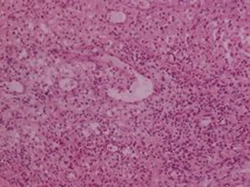 Malakoplakia of the Urinary Bladder: Aggregates of Large Macrophages (HEx200) Malakoplakia of the Urinary Bladder: Aggregates of Large Macrophages (HEx200)