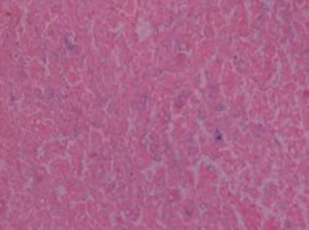 Michaelis-Gutmann Bodies, Perl Stain Positive (x400) Michaelis-Gutmann Bodies, Perl Stain Positive (x400)