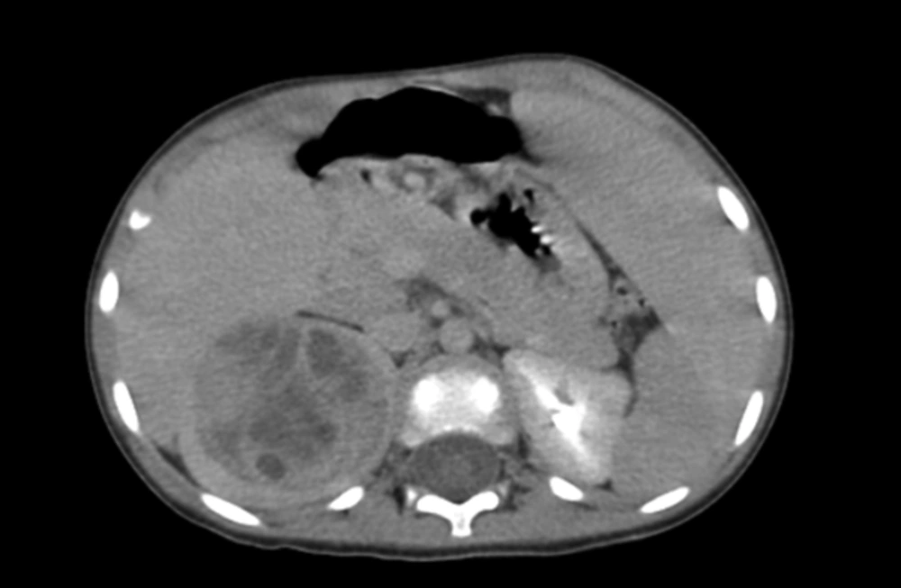 CT Scan Showed a Well-Defined Solid and Cystic Mass in the Right Kidney. CT Scan Showed a Well-Defined Solid and Cystic Mass in the Right Kidney.