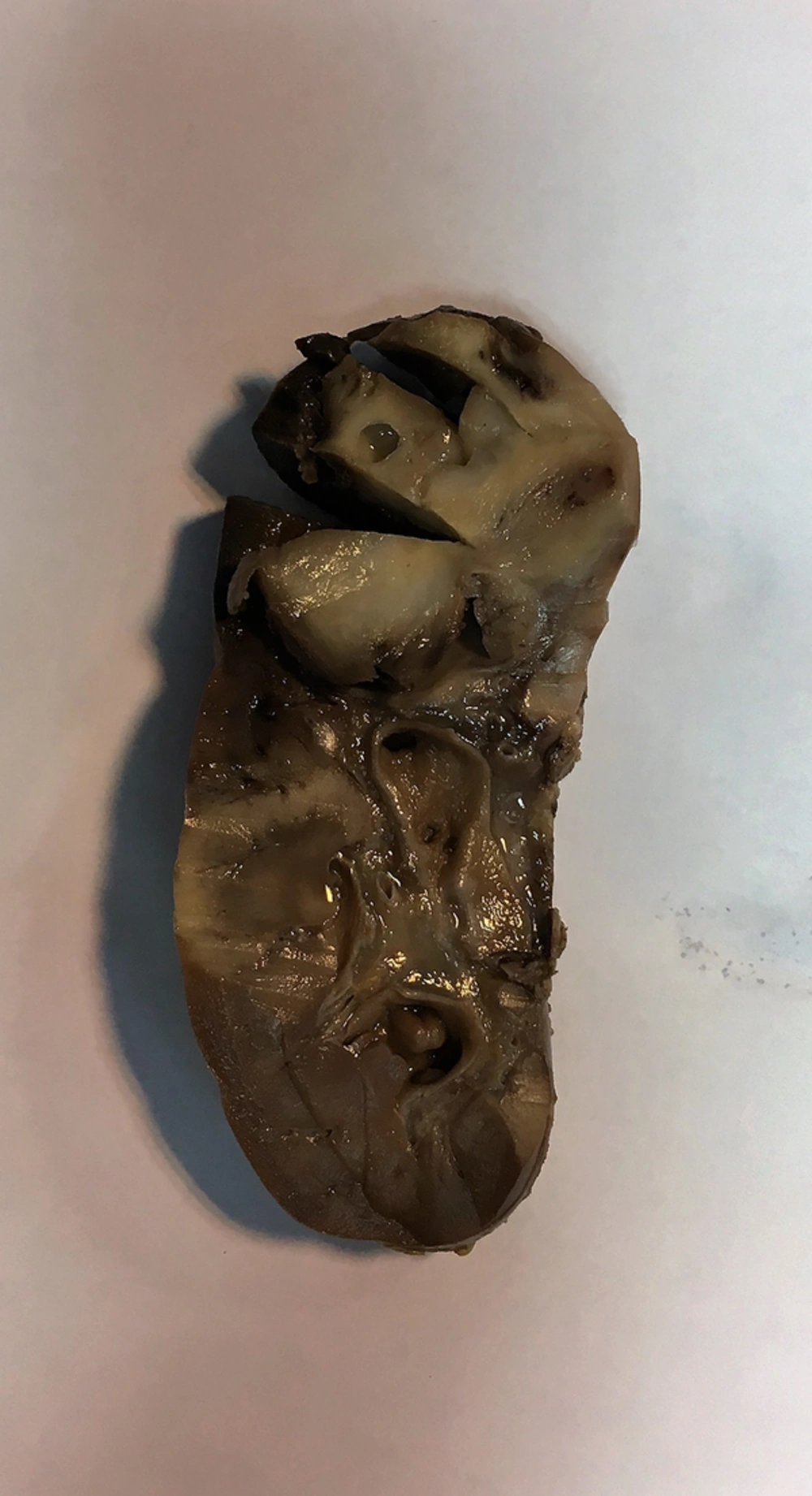 A Round Solid and Cystic Mass in the Upper Pole of the Kidney. A Round Solid and Cystic Mass in the Upper Pole of the Kidney.