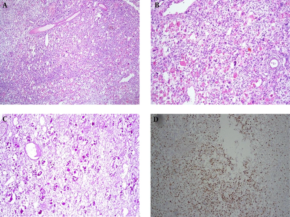 A, Sections From Liver Mass Showed Hypercellularity Composed of Hyperchromatic Nuclei with Severe Anisonucleosis and Many Mitotic (H&E (H&E staining; X100); B, Many Intra- and Extracellular Hyaline Globules Were Present; C, The Hyaline Globules Were PAS-Positive and Diastase Resistant; D, Ki-67 Was High. A, Sections From Liver Mass Showed Hypercellularity Composed of Hyperchromatic Nuclei with Severe Anisonucleosis and Many Mitotic (H&E (H&E staining; X100); B, Many Intra- and Extracellular Hyaline Globules Were Present; C, The Hyaline Globules Were PAS-Positive and Diastase Resistant; D, Ki-67 Was High.