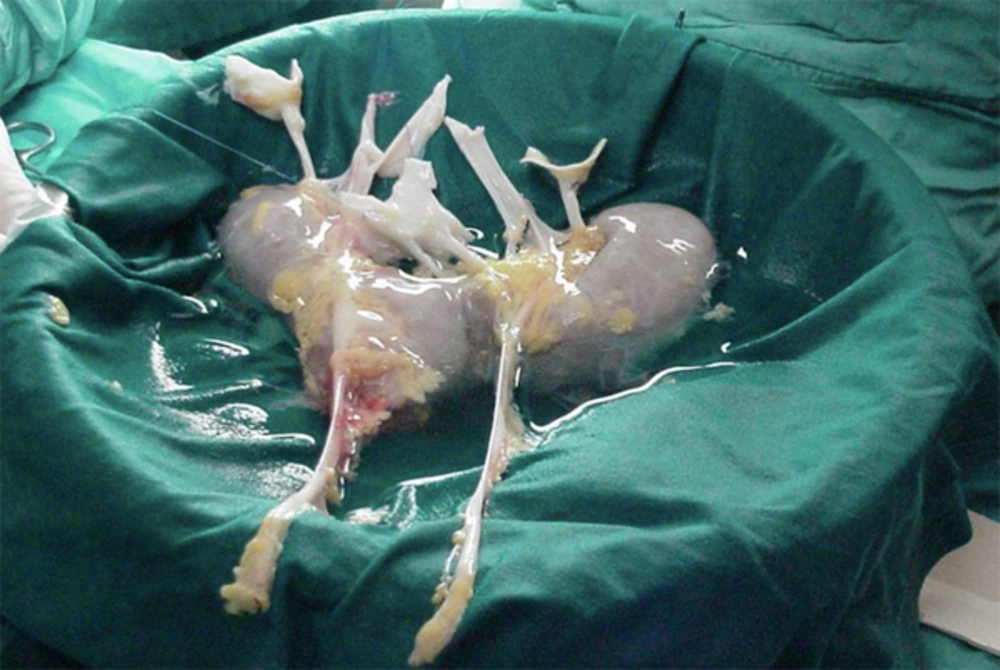 Bench Surgery Using Methylene Blue to Stablish Vascular Distribution and Parenchimatous Isthmus. Bench Surgery Using Methylene Blue to Stablish Vascular Distribution and Parenchimatous Isthmus.