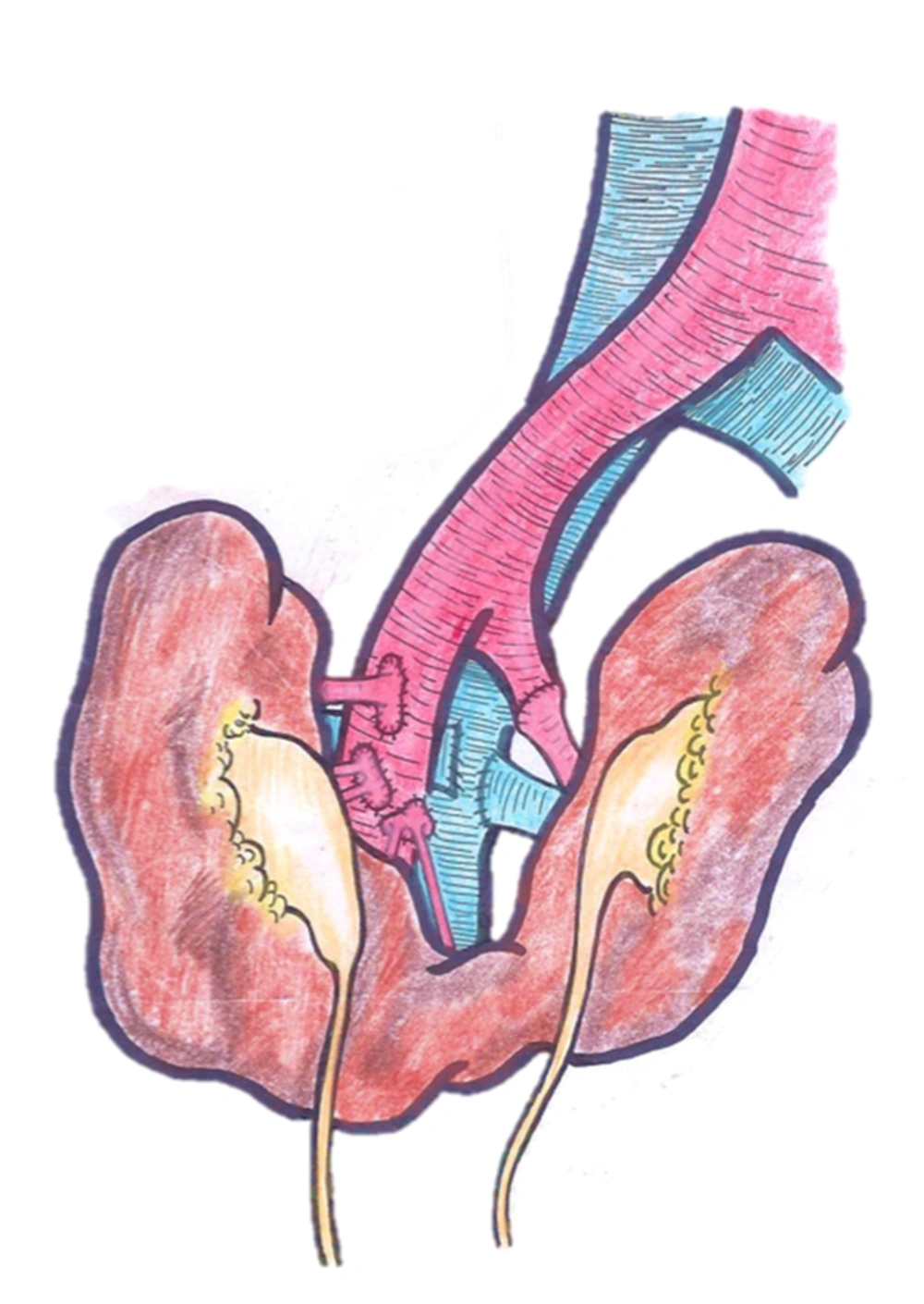 Picture Showing Multiple Vascular Anastomosis Picture Showing Multiple Vascular Anastomosis