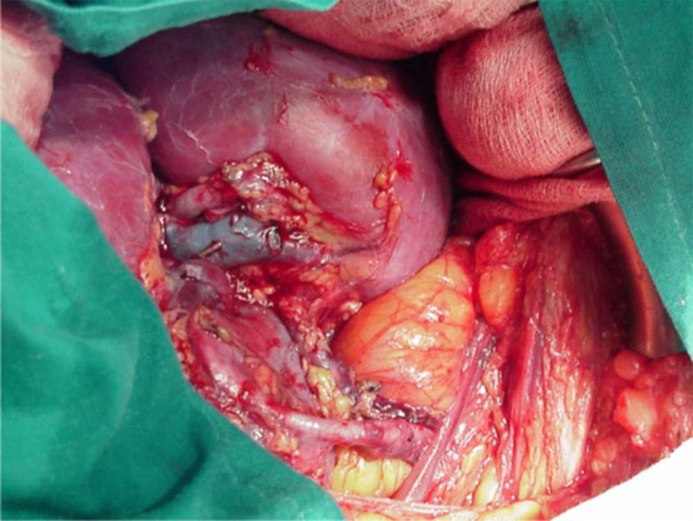 Intraoperative Image After Revascularization of the Allograft Showing Vessel Disposition and Ureteroneocistostomy Intraoperative Image After Revascularization of the Allograft Showing Vessel Disposition and Ureteroneocistostomy