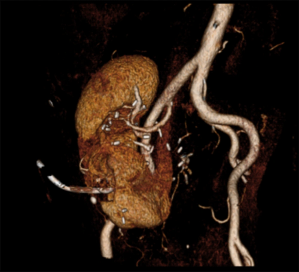 CT Scan with 3D Reconstruction Allows a Good Visualization of Vascular Tree and the Percutaneous Nephrostomy Placed Previous to Stone Resolution CT Scan with 3D Reconstruction Allows a Good Visualization of Vascular Tree and the Percutaneous Nephrostomy Placed Previous to Stone Resolution