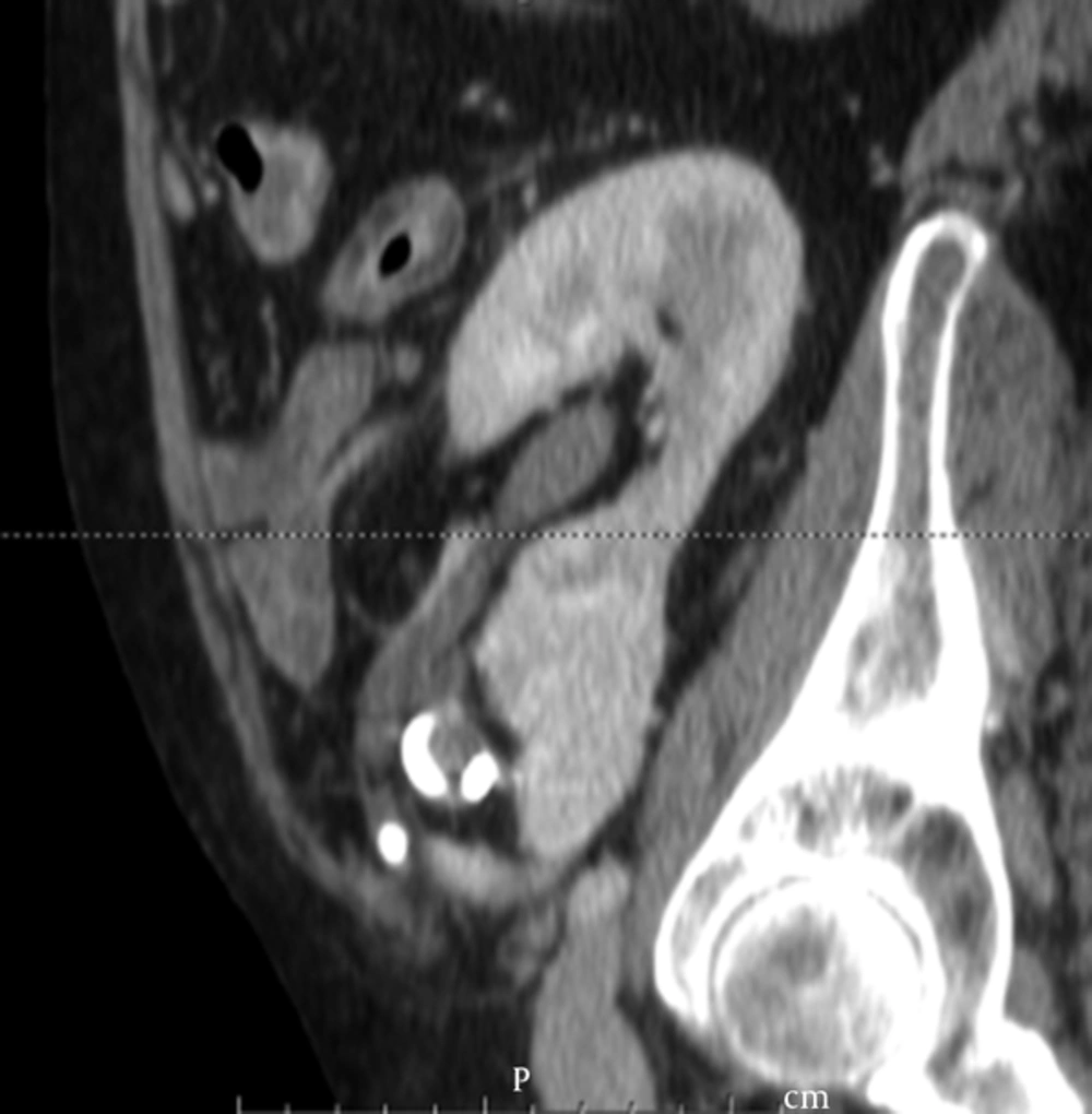 Sagital View of the Eight Millimeter Uric Stone Causing Ureteric Obstruction Sagital View of the Eight Millimeter Uric Stone Causing Ureteric Obstruction
