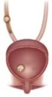 Mean Urinary Cytokine MCP-1 in Children with Urinary Tract Obstruction and Healthy Children