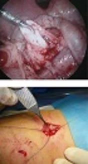 Laparoscopic-Assisted Extracorporeal Pyeloplasty: A Minimally Invasive Approach to Pediatric Ureteropelvic Junction Obstruction